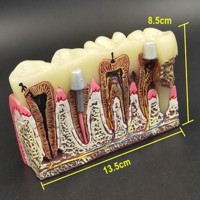 1 Stück Dentalzähne, häufige Pathologien, Modell, Lehrmodell, Zahn, Zahnarzt für medizinische Wissenschaft, Lehre, zahnmedizinisches Kommunikationsmodell
