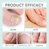 Nail Fungal Treatment Ointment Anti Infection Paronychia Onychomycosis Soft Hand Feet Toenail Repair Damaged Health Care Cream