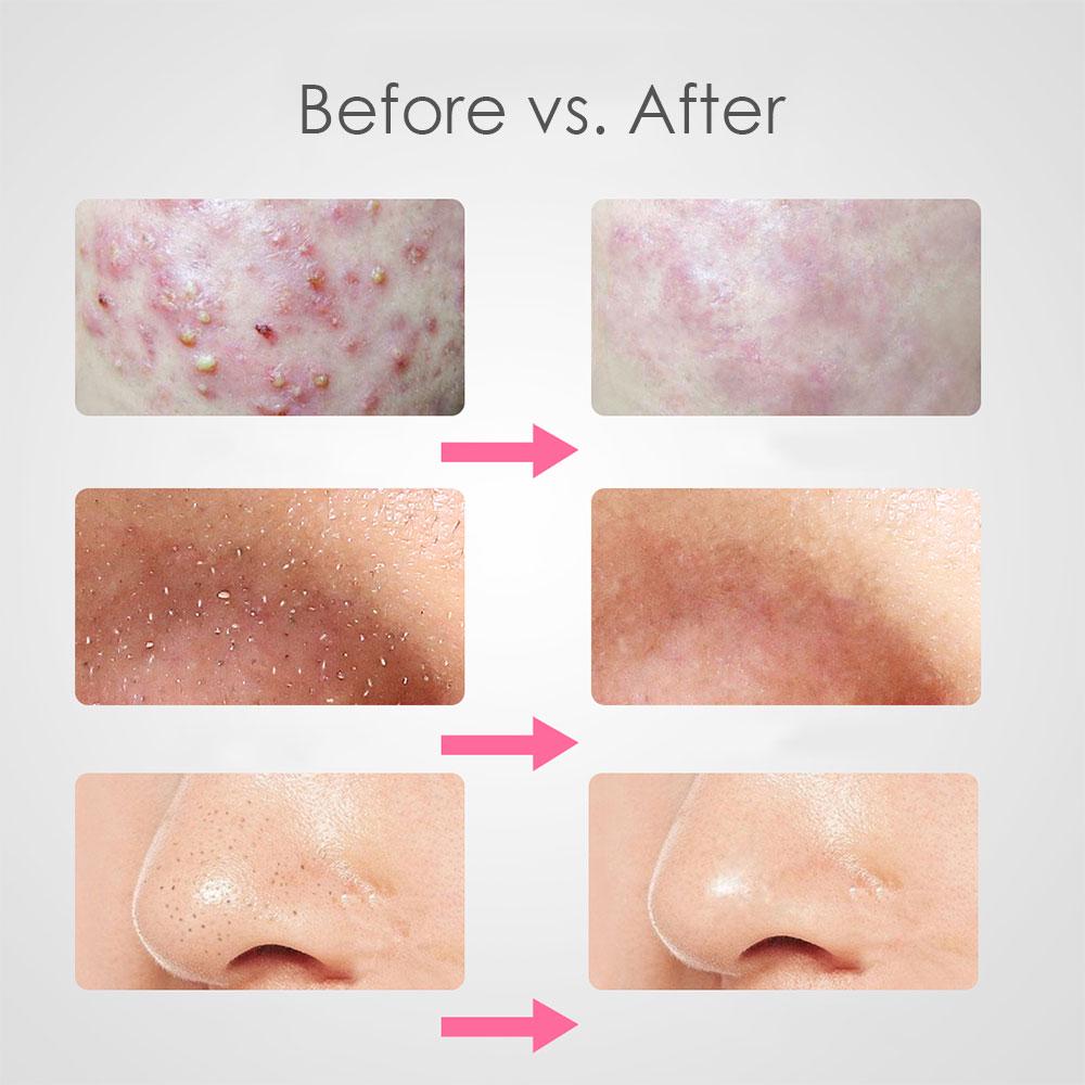 7Pcs Blackhead Extractor Tool Vacum Blackhead Remover Tweezer for Pimple Blemish Acne Extractor