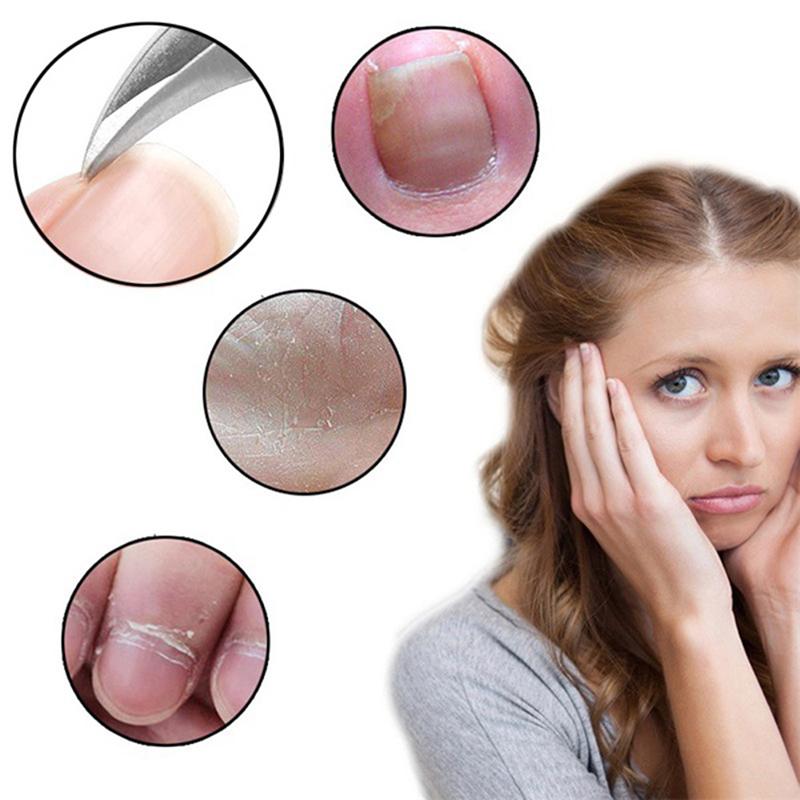 

2шт вросшие ногти педикюр инструмент для ухода за ногами коррекция ногтей кусачки фрезы