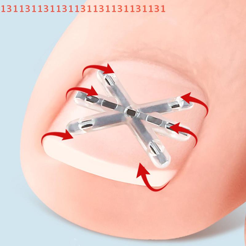 2 Pcs Ingrown Toenail Correction Tool Ingrown Toenail Treatments Elastic Patch Sticker Toenail Straightening Pedicure Tools
