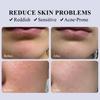 Galactomyces 95 Tone Balancing Essence-Hydrating & Moisturizing-Reduce Reddish-Suitable For All Skin Types, 120ml