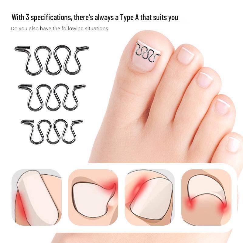 Stretchable Small Invisible Ingrown Toenail Patch with Nickel Alloy Coil Wire for Nail Correction, Fits in Shoes.