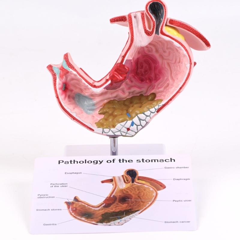 Diseased Stomach Model Stomach Anatomy Model Pathological Stomach Model For Medicals Students And Healthcare Learning