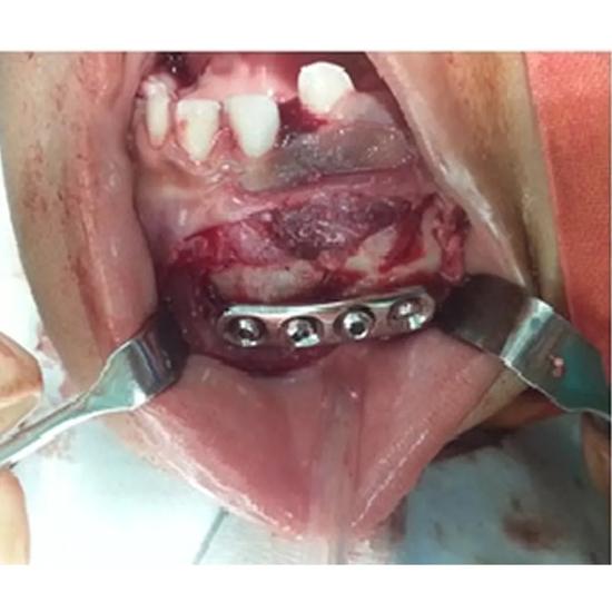 GDC Cheek Retractor Langenbeck - 40x13 (21.5cm) (CRL3)