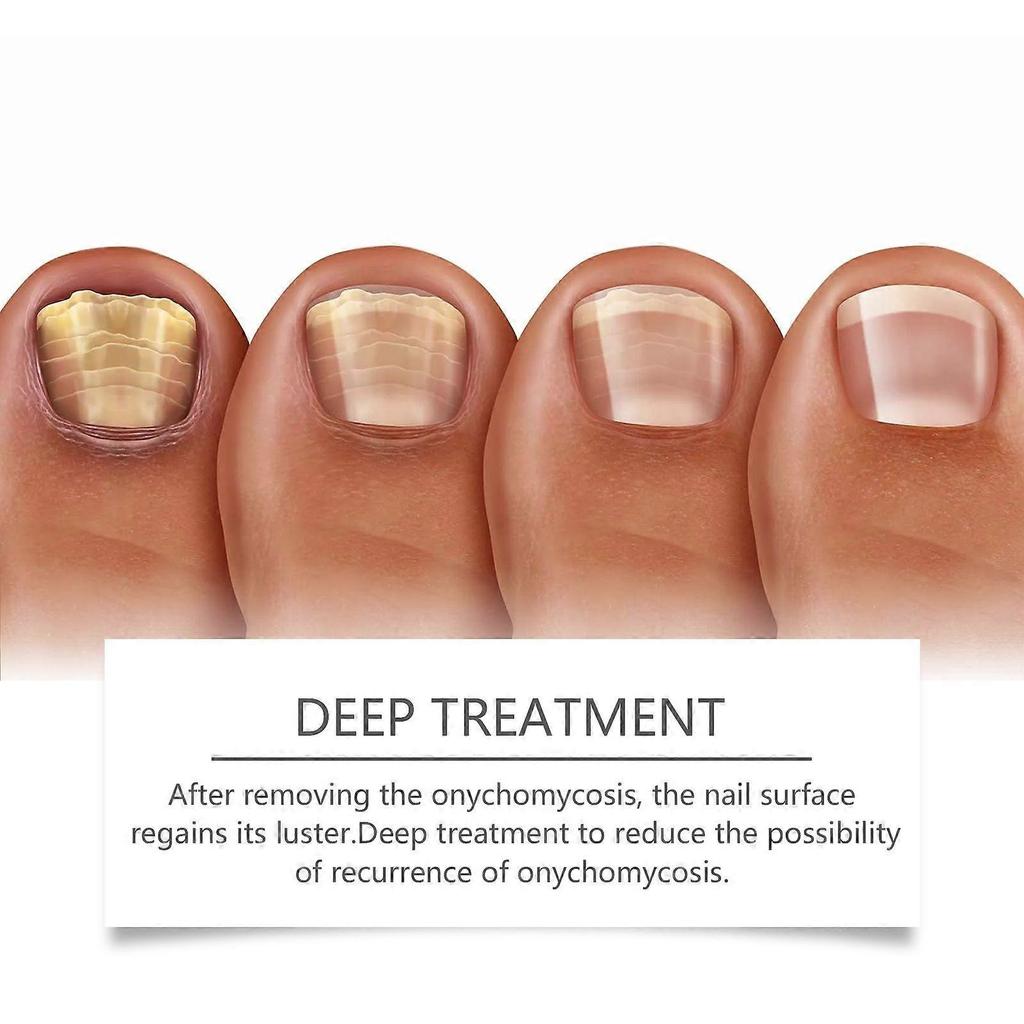 Limited time!!Eohoe Handheld Nail Care Device For Nail Fungus, Gentle Cleaning And Repair For Fingernails And Toenails