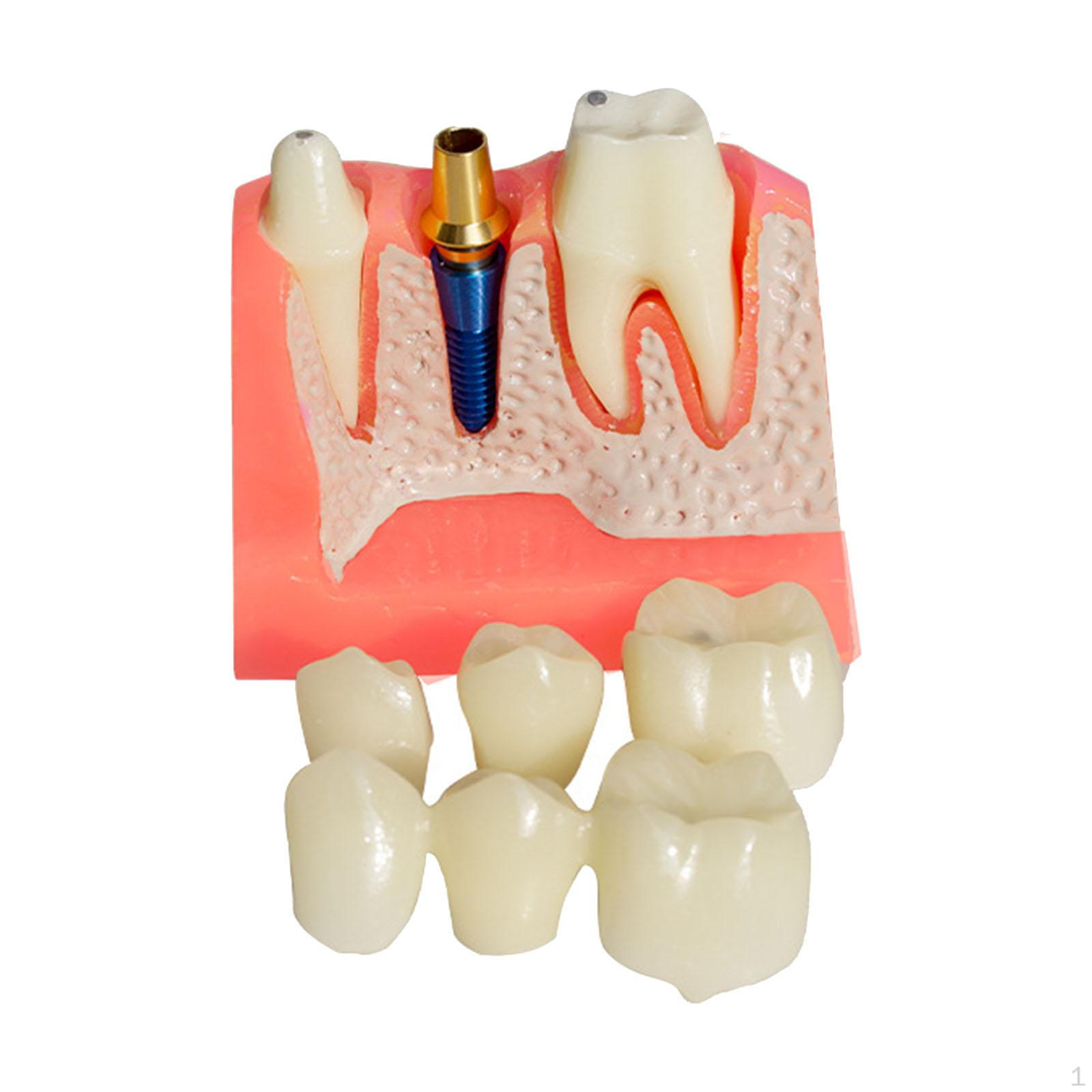 Dental Implant Model Reusable 4x for Communication Hand on Practice Studying