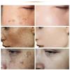 Freckle Remove Cream Whiten Face Cream Firming Moisturizing Anti-wrinkle Spot-removing Facial Cream Beauty Skin Care Serum