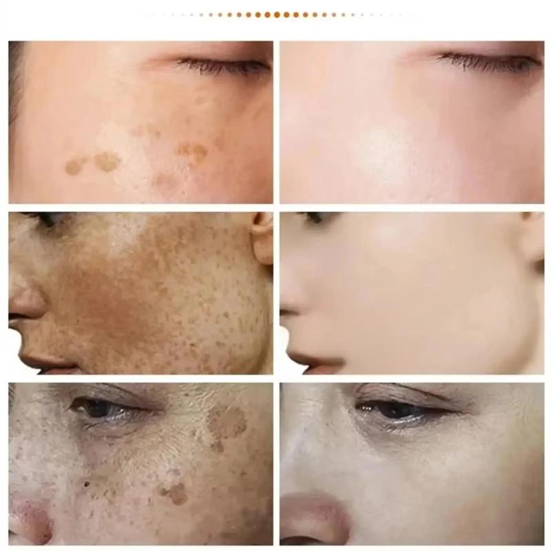 Freckle Remove Cream Whiten Face Cream Firming Moisturizing Anti-wrinkle Spot-removing Facial Cream Beauty Skin Care Serum