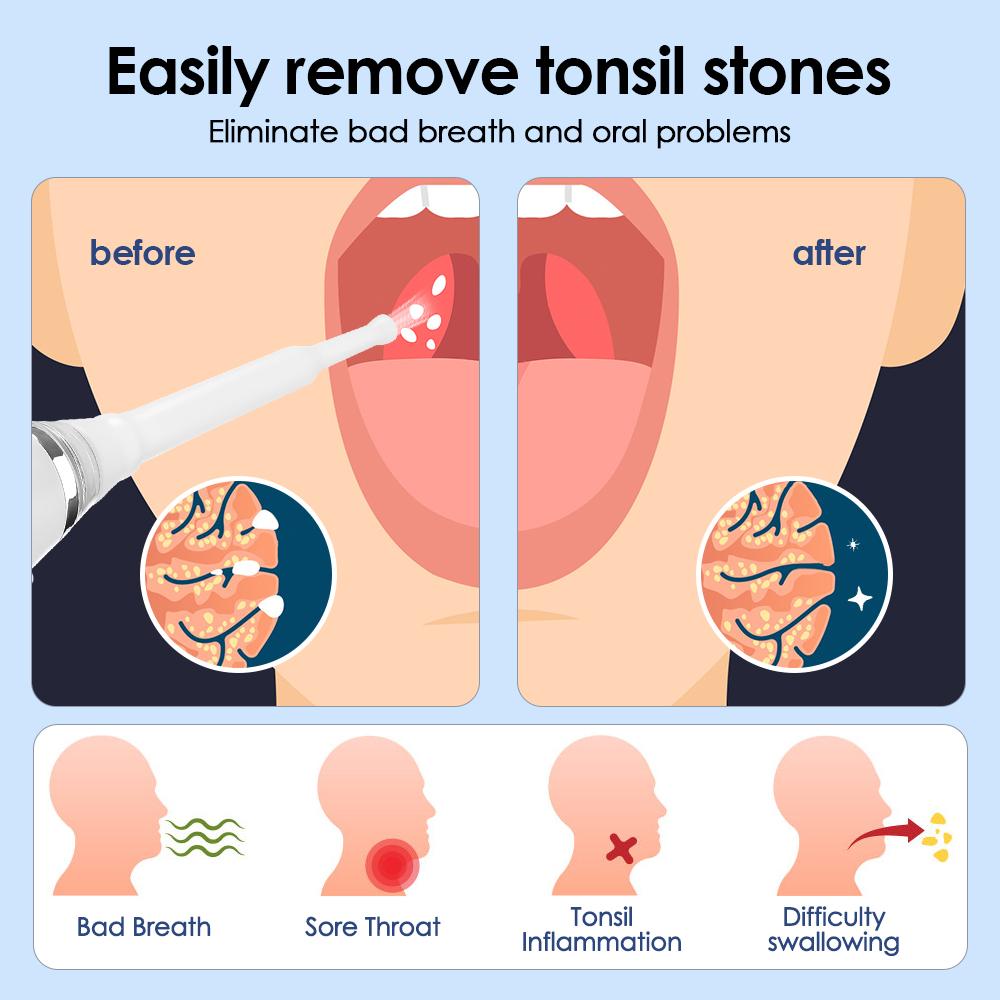 Electric Tonsil Stone Remover With Irrigation Syringe Instant Suction Vacuum Tonsil Stone Removal Kit Mouth Clean Tool Oral Care