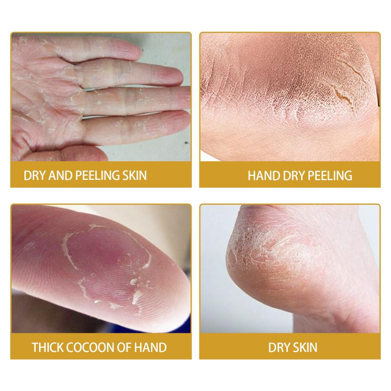 Eelhoe Skin Crack Banana Repair Cream Foot Care Anti Drying Crack Anti Freezing Crack Hand And Foot Care Repair Cream