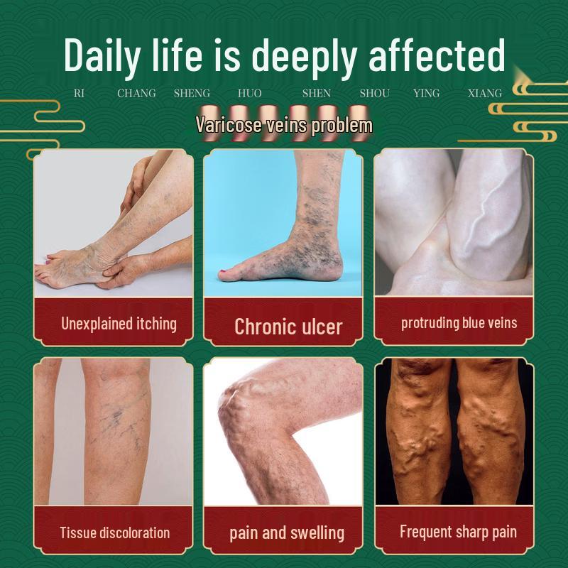 Jinyi Varicose Vein Cold Compress Gel