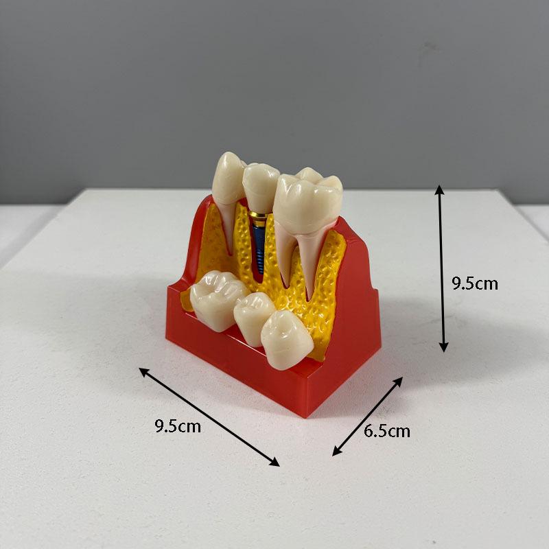 Прозора Знімна Повна Модель Щелепи з М'якими Яснами та Зубами для Підготовки до Імплантації