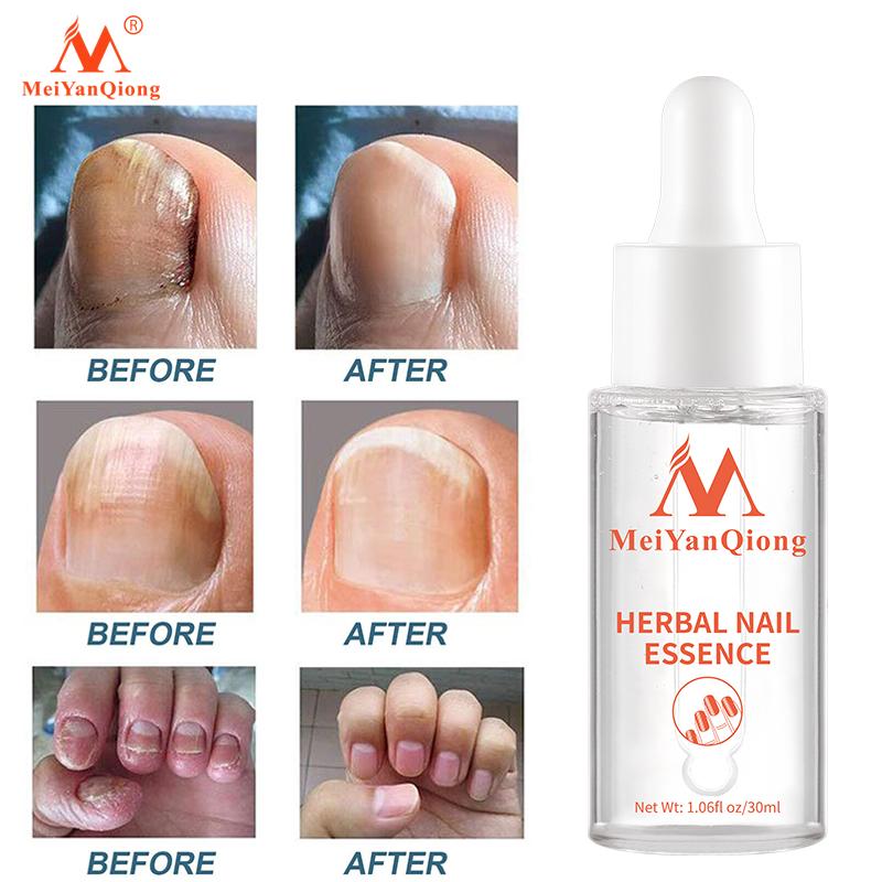 Herbal Nail Treatment Essential Oil Hand and Foot Whitening Toe Nail Removal Feet Care Polish Nail Gel Nail Repair Treatment