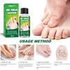 Hbesty Herbal Nail Fungus Treatment Liquid For Effective Foot Care And Healing