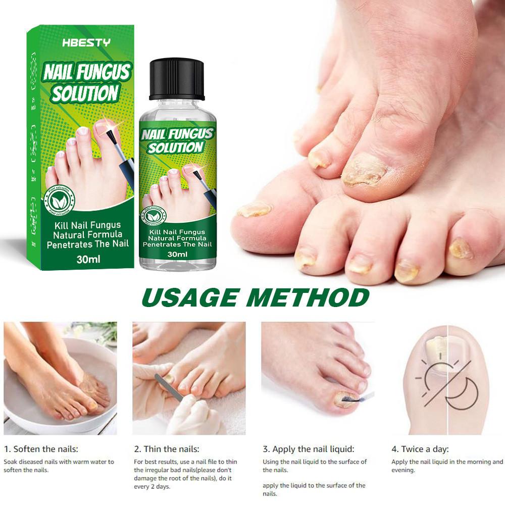Hbesty Herbal Nail Fungus Treatment Liquid For Effective Foot Care And Healing
