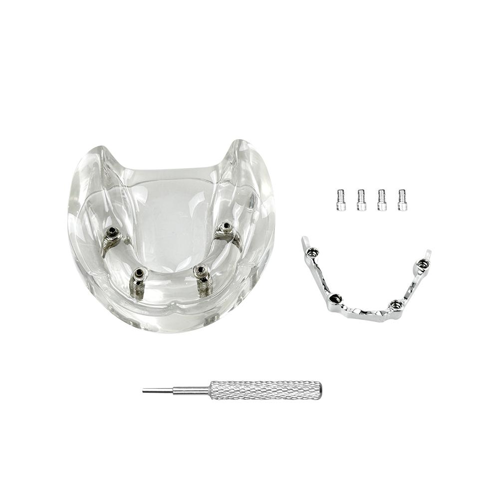 Dental Teeth Model With Implants Gold/Silver Bar Type Overdenture Restoration Treatment Typodont For Dentist Patient Teaching