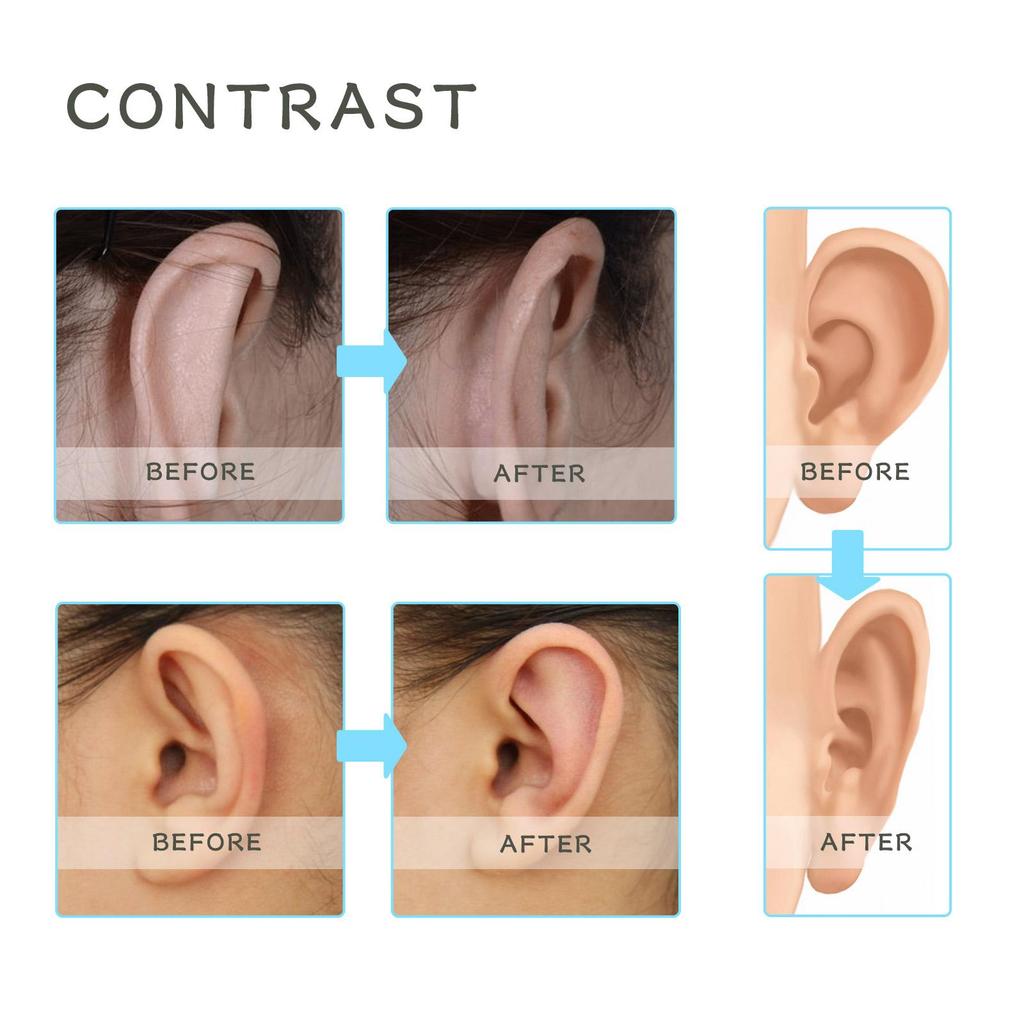 WIIEEY Silicone Auricular Correction Stickers Help Children Correct Dilated Ears Breathable and Waterproof Stickers