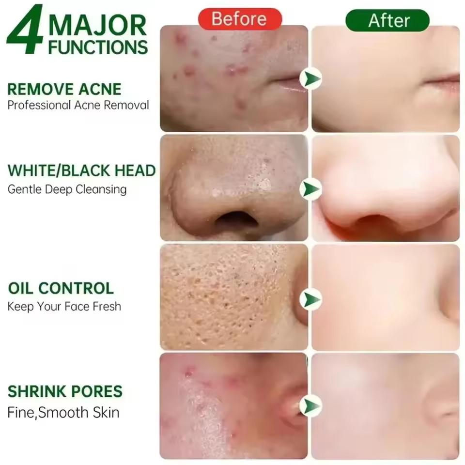Salicylic Acid Pore Clearing Cream Shrink Pores Remove Blackheads Acne Brighten Moisturizing Smooth Skin Care Korean Products