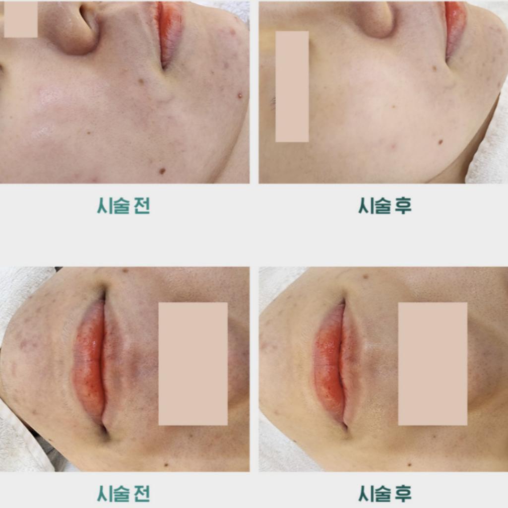 [iLLON] MESOPRO+ MTS Ampoule