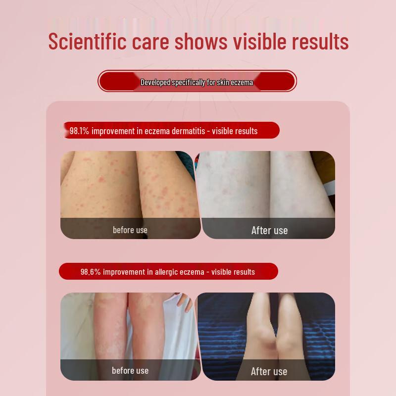 Jing Peitang Calamine Nettle Anti-Itch Soap