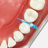 Coins composites dentaires, coins interdentaires adaptatifs, dentisterie, accessoires pour la thérapie de l'espacement des dents