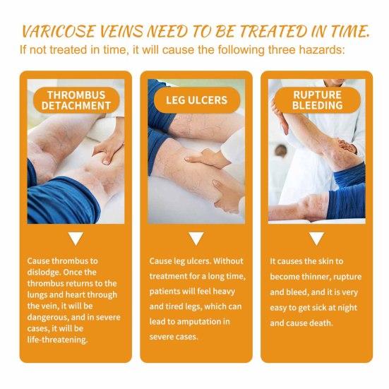 60G Varicose Vein Cream Natural Relief Promotes Healthy Circulation Vitamin K Cream for Leg Soreness Swelling