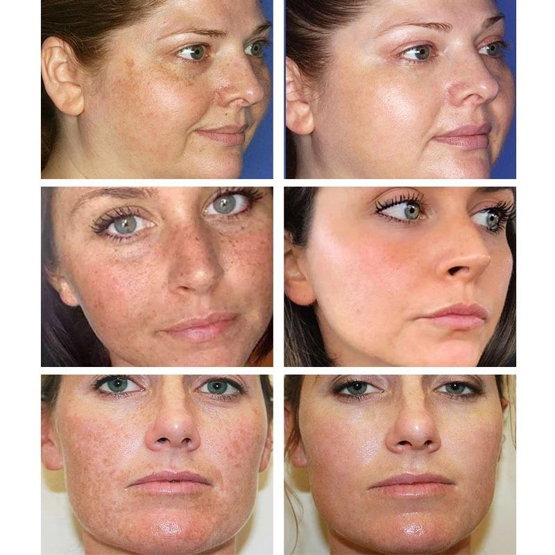Sérum Blanchissant Anti-Taches Pigmentaires Correcteur de Mélanine Visage Taches de Rousseur Éclaircissant Beauté Soin de la Peau Coréen Jour Nuit