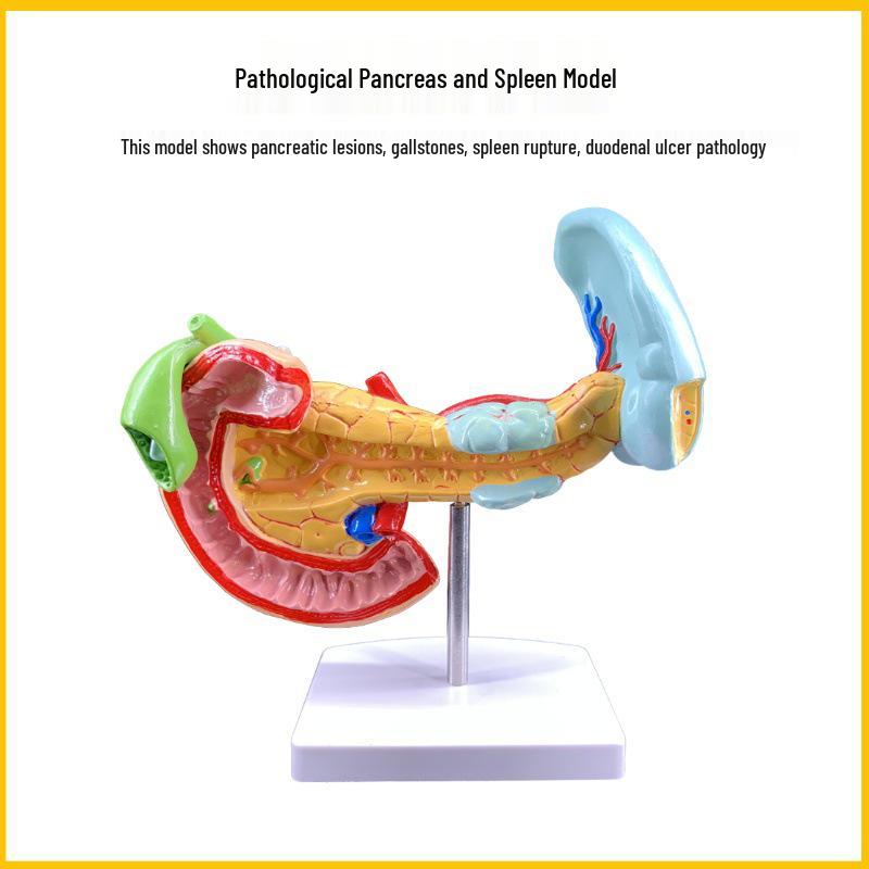 Spleen & Pancreas Pathology Model: Lesions & Anatomy