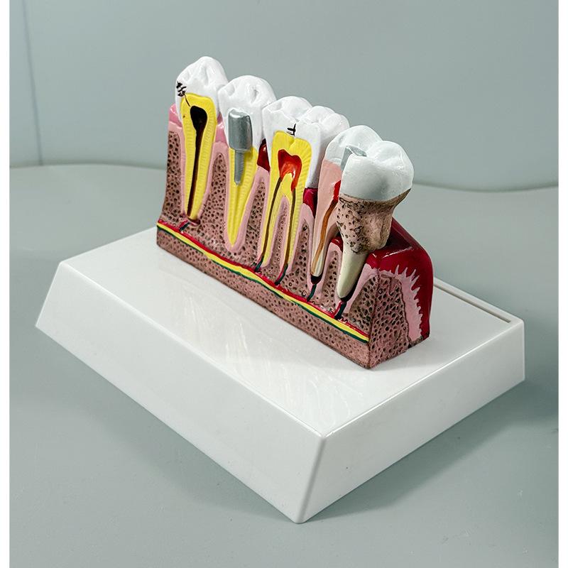 Прозора Знімна Повна Модель Щелепи з М'якими Яснами та Зубами для Підготовки до Імплантації