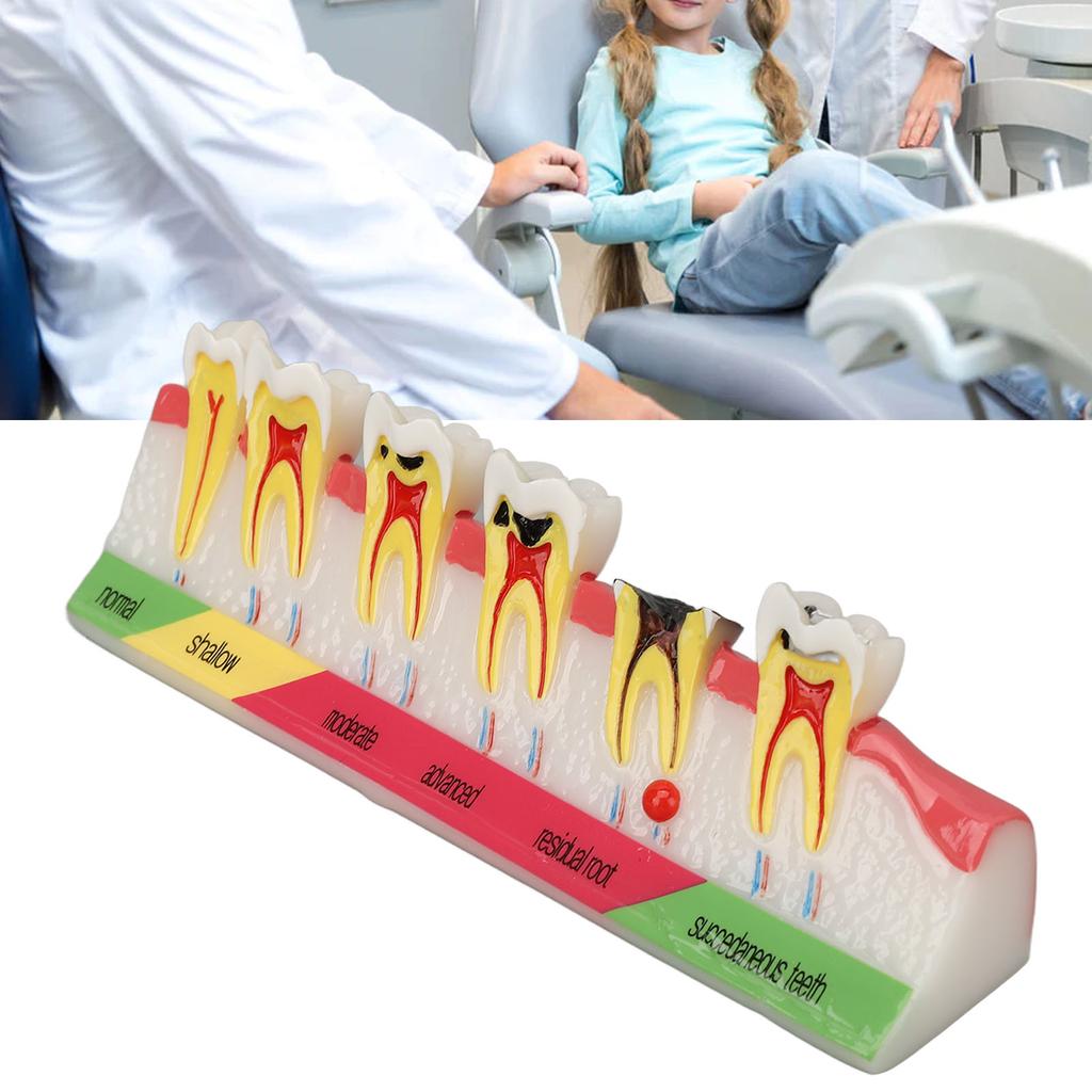 Dental Caries Model 6 Different Stages Resin Decayed Tooth Display Model