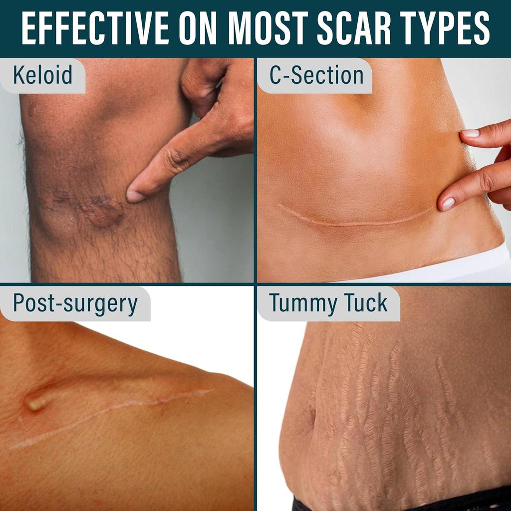 Silicone Scar Tape for Scars Professional Tape Reusable Removal Sheet C-section Burns Acne Keloids, etc., 1.5" x 120