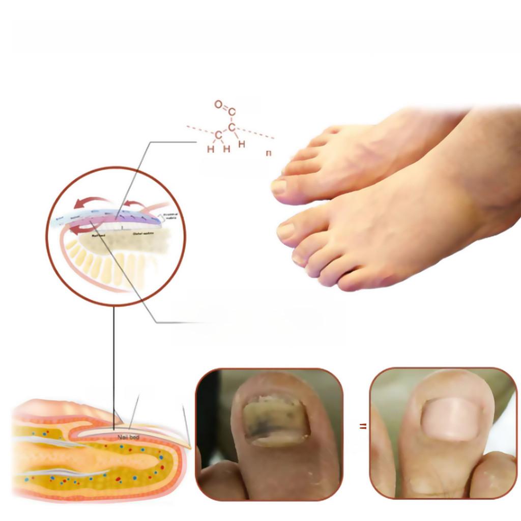 Comprehensive Nail Care Treatment South Moon Targets Yellow Nails Ingrown Nails