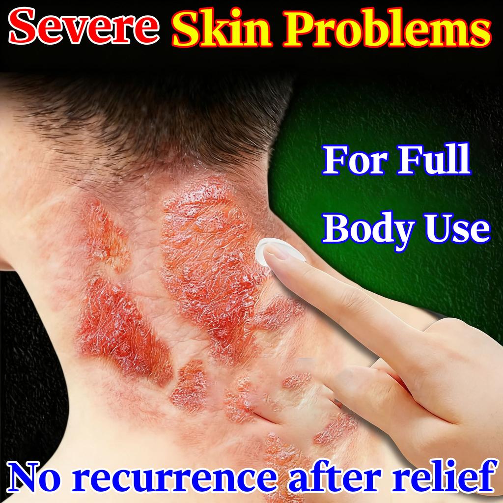 Natural Eczema & Dermatitis Cream - Soothes Skin Issues Gentle & Non-Irritating