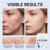 Microneedle Patches, 9 Packs Dissolving Pimple Patches for Face, Overnight Stickers with Hydrocolloid, Zit Patches for Blemishes