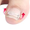 Ingrown Toenail Corrector Kit for Curved Nail Stainless Steel Armor Buckle Toe Nail Straightener Ingrown Nail Tool