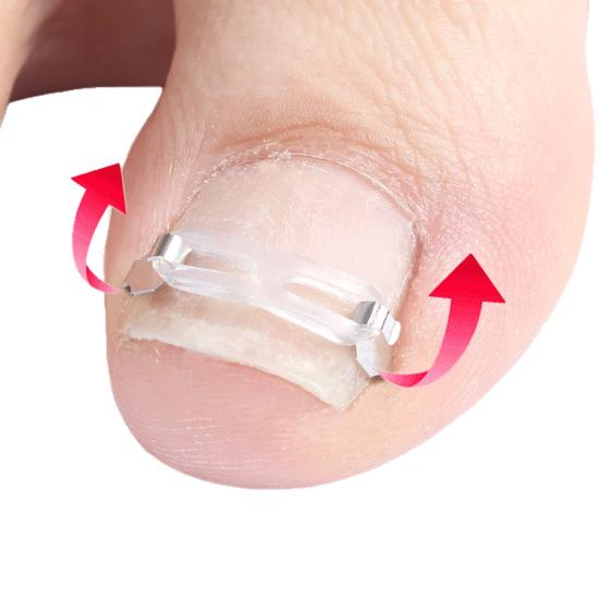 Ingrown Toenail Corrector Kit for Curved Nail Stainless Steel Armor Buckle Toe Nail Straightener Ingrown Nail Tool