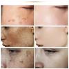 Whiten Cream Brighten Face Effective Remove Melasma Dark Spot Improve Dullness Skin Anti-pigmentation Care Cream Care Products