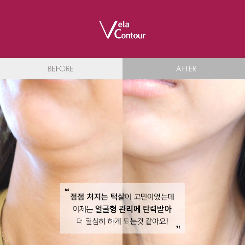 Velacontour Neck Wrinkles Jawline Deep Ball Elasticity Lifting Ampoule 30ml 13 Clinical Trials Completed