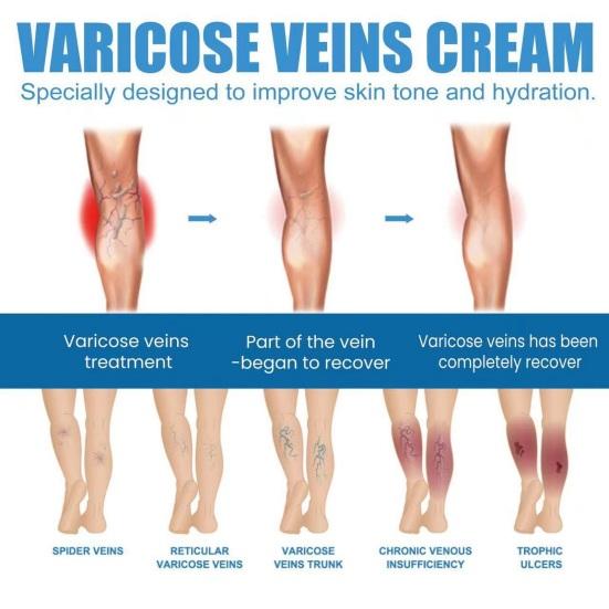 Yousheng 30ML Varicose Vein Massage Spray Relieve Leg Discomfort Improve Circulation Gentle Effective Varicose Spray