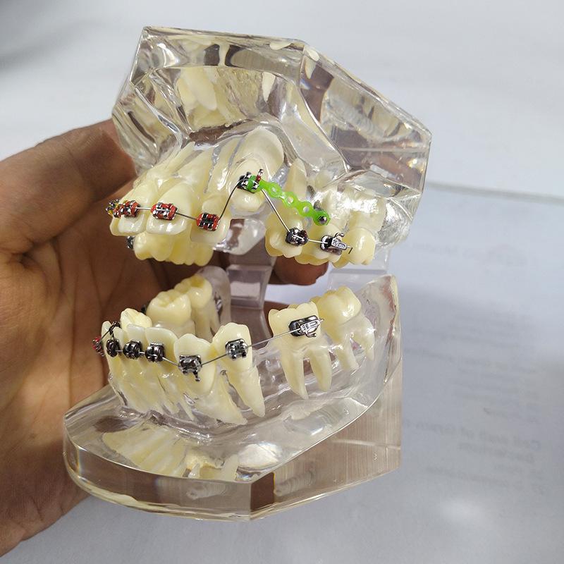 Прозора Знімна Повна Модель Щелепи з М'якими Яснами та Зубами для Підготовки до Імплантації