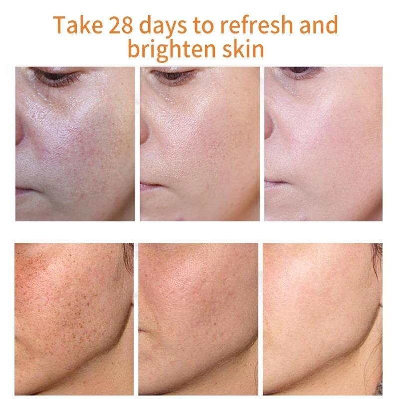 Whitening and Freckle Removing Cream Fading and Gentle Freckles Removing Freckle Age Freckle Melasma Repair Cream