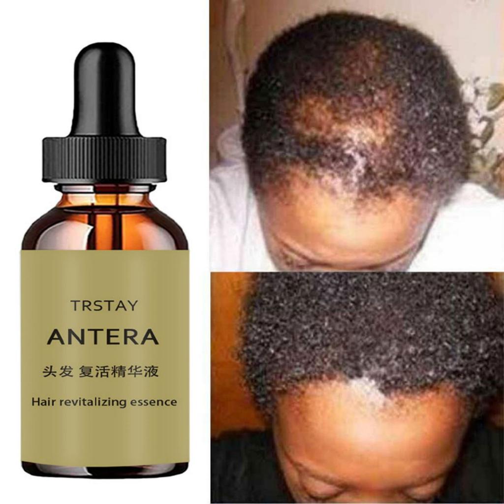 Эфирное масло для быстрого роста волос, эффективное лечение выпадения ...