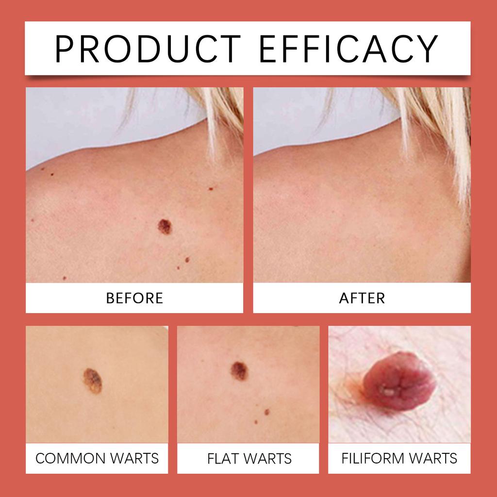 Skin Care Patches For Flat s, Facial And Eye Care Patches Effectively Reduce Keratin And Smooth The Skin.