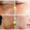 Powerful Spot-Removing Whiten Cream Brighten Skin Fast Eliminates Melanin Pigmentation Melasma Dark Spots