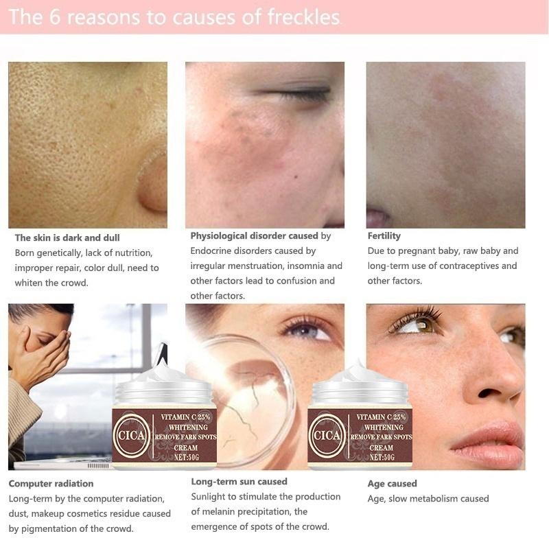 Women New Skin Brightening Cream&Freckle Cream&Dark Spot Corrector Remover for Face & Melasma Blemishes