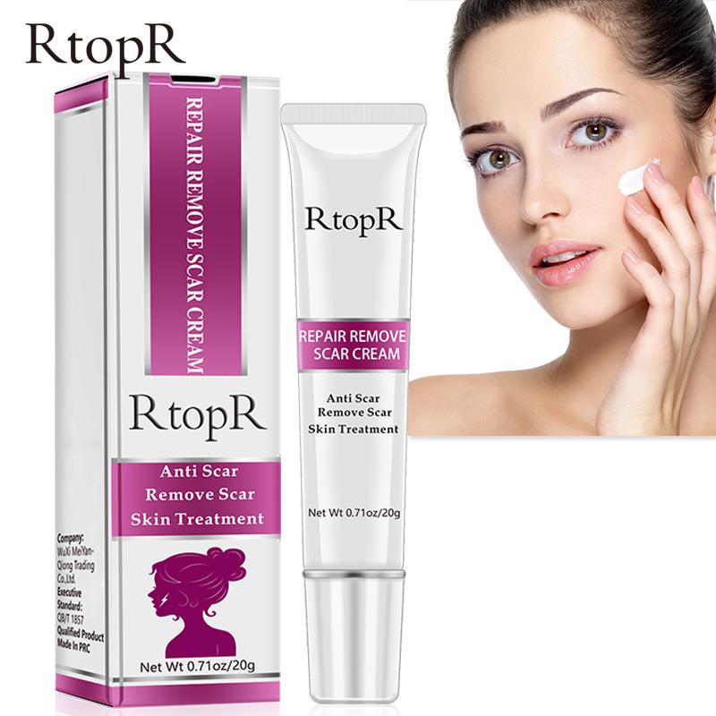 cream to remove acne marks on face