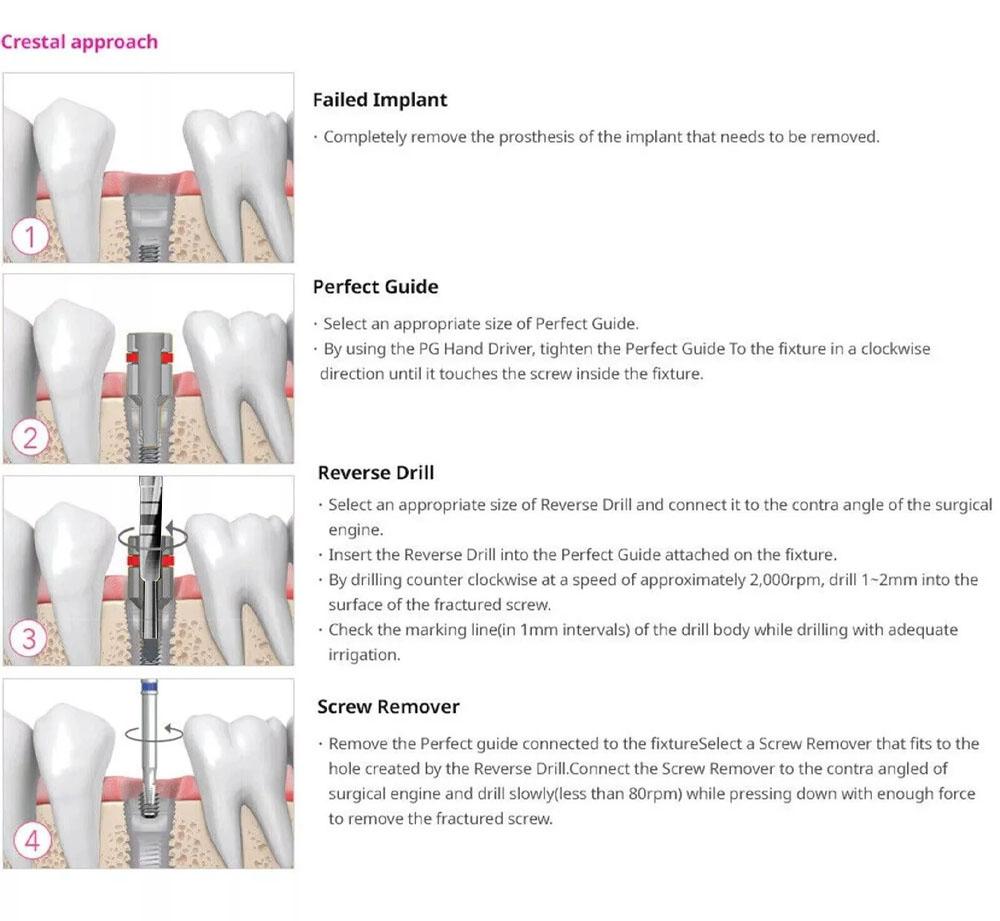 Dental İmplant Kırık Vida Çıkarma Kiti Kırık Vida Sökücü Kit Diş Aleti İmplant Cerrahi Aleti