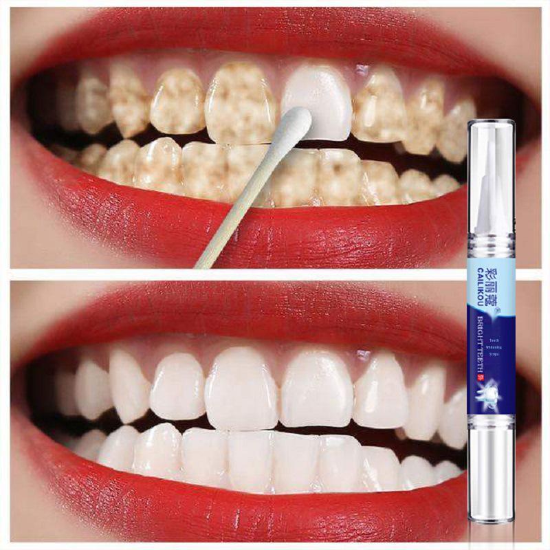Teeth Whitening Pen - Removes Stains, Brightens & Cleans Yellow Teeth
