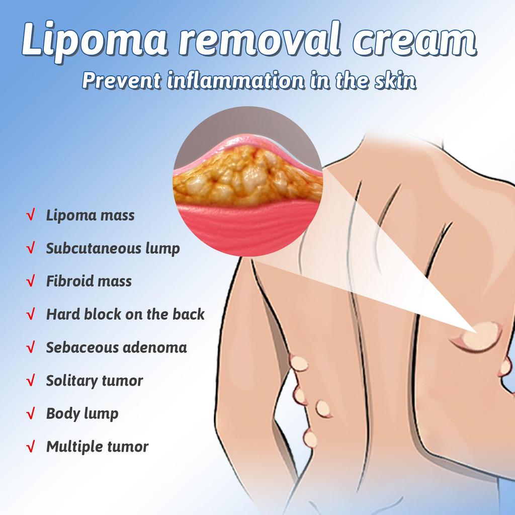 South Moon Fatty Knot Cream Fat Bump Relief Tumor Elimination Cream Lump Hardness Improvement Fatty Knot Cream